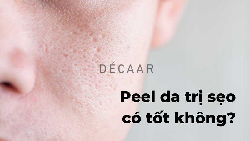 peel da trị sẹo rỗ